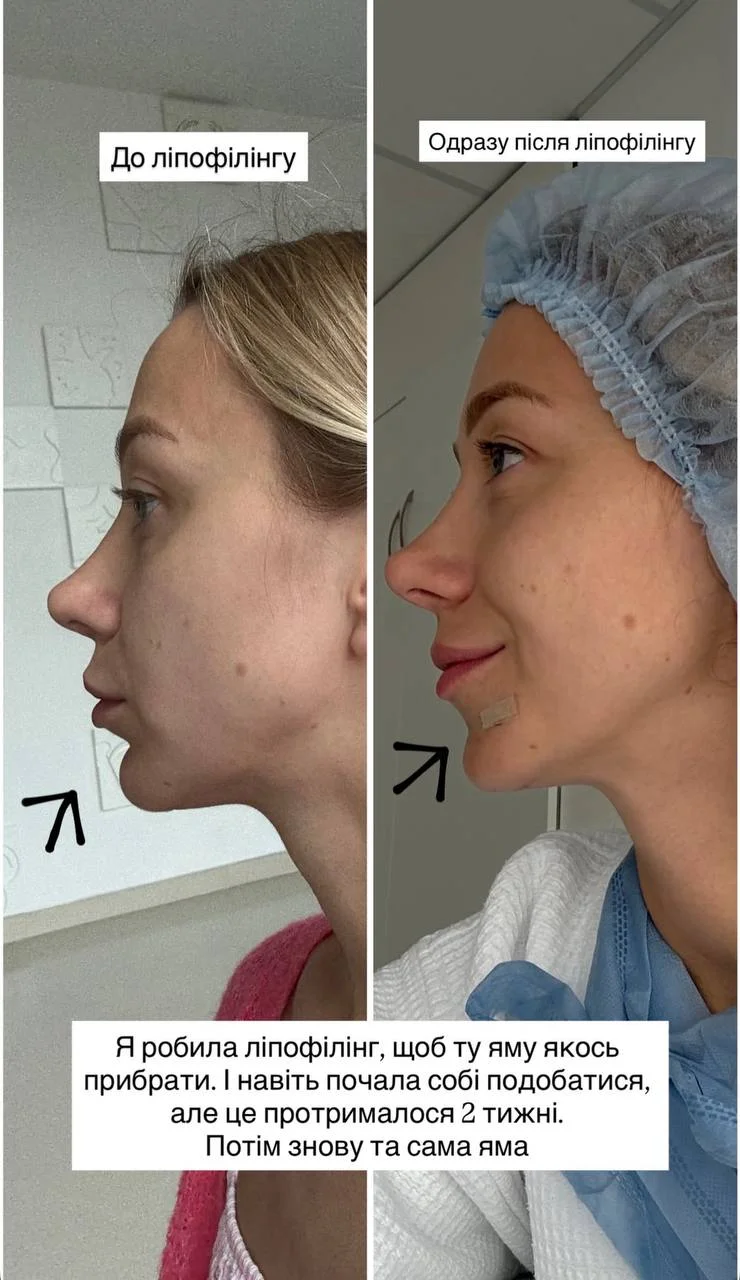 Дружина Павліка шокувала наслідками невдалої пластики: фото до та після